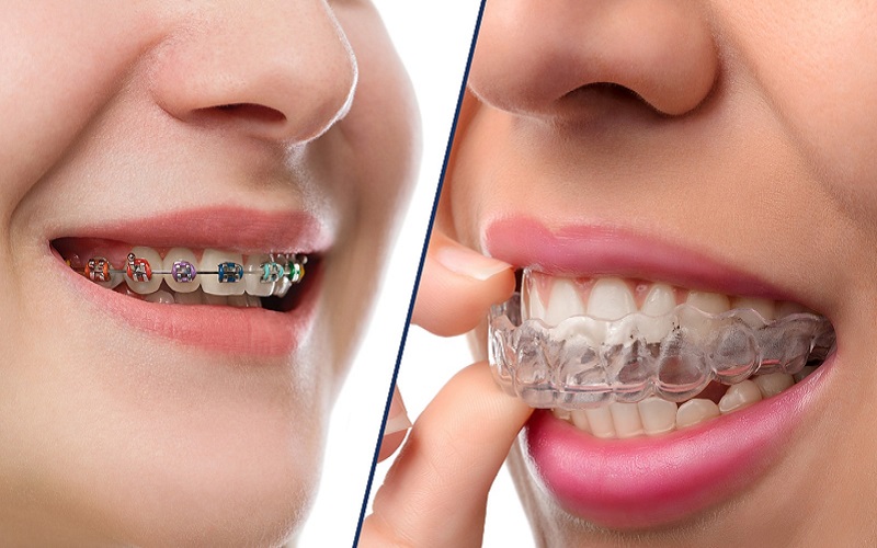 Invisalign vs. Braces